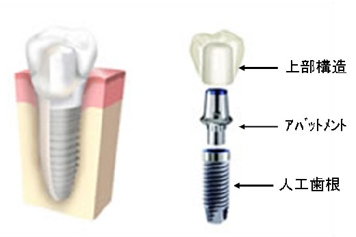 インプラント.jpg